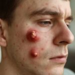 Фурункулёз бьёт по шахтам урала